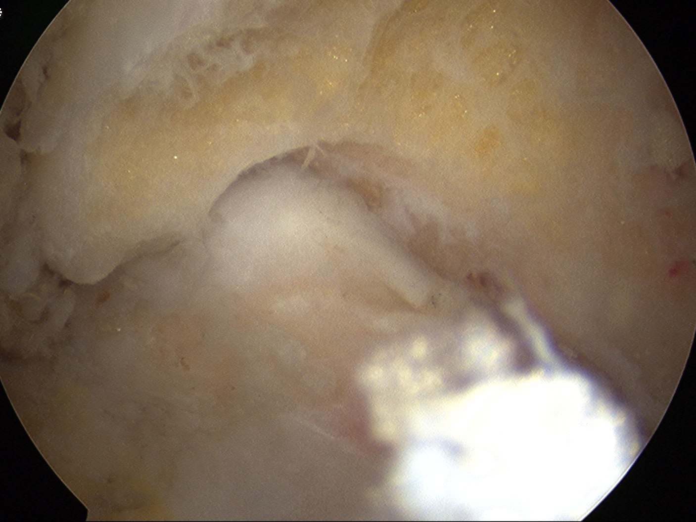 Elbow Malunion Partial Debridement